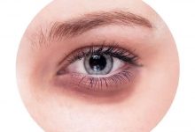 有什么辦法可以消除黑眼圈-菲菲美人館