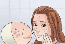 房事能治療青春痘嗎?5種方法擺平你的痘肌-菲菲美人館